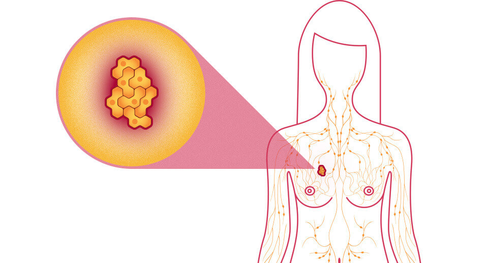 Breast Cancer: Understanding the Causes and Recognizing the