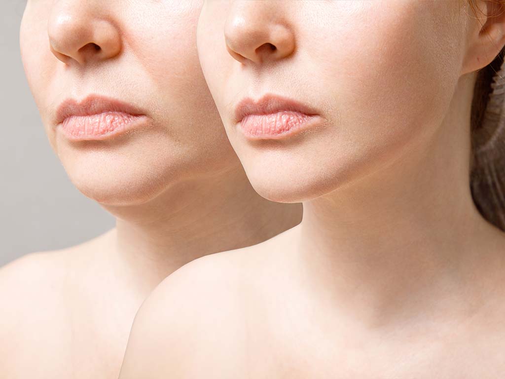Morpheus8 is a Trending Cosmetic Treatment